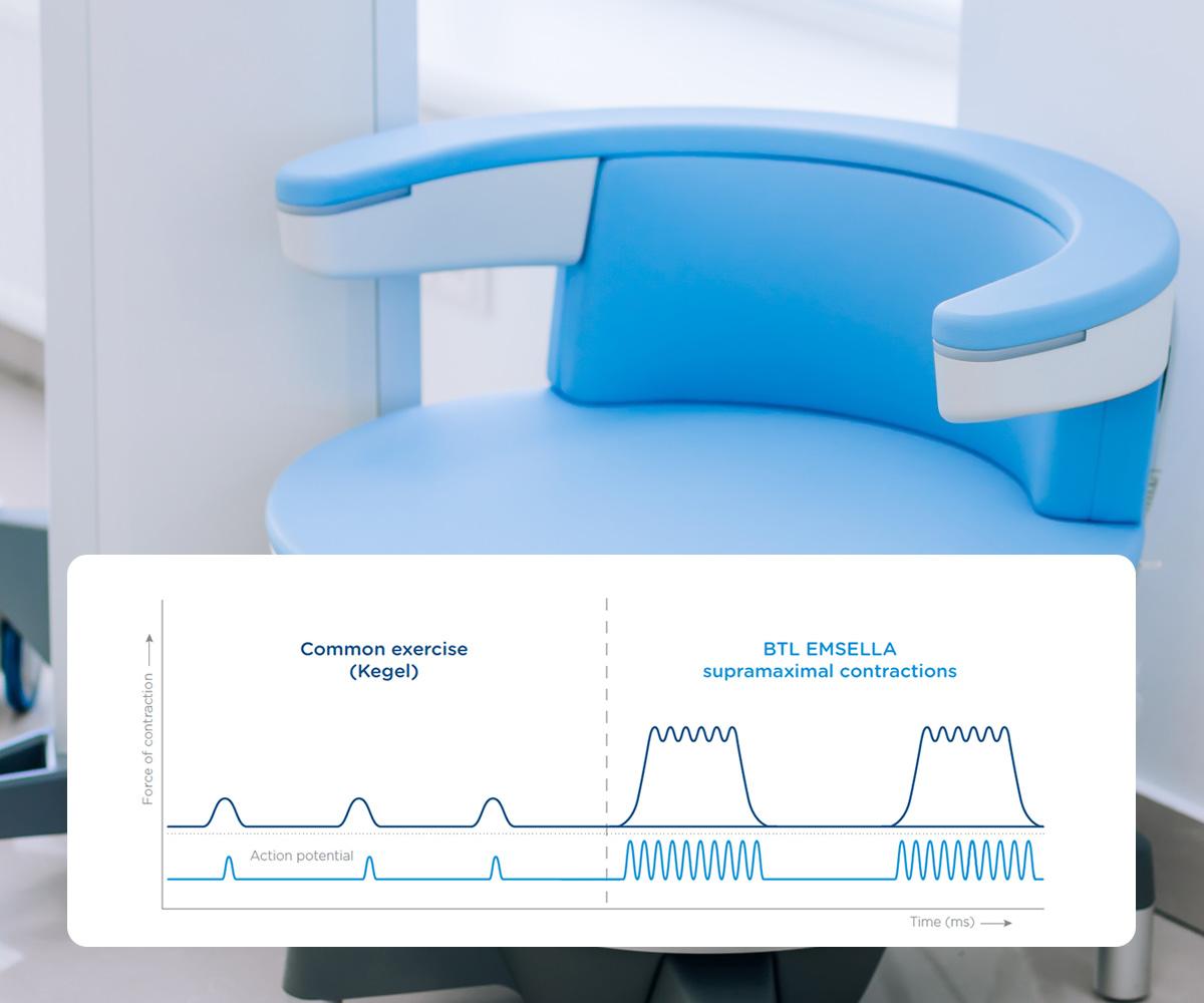 How does BTL Emsella Work? | Pelvic Floor Treatment & Restoration | Alderley Edge, Cheshire How does BTL Emsella Work? | Pelvic Floor Treatment & Restoration | Alderley Edge, Cheshire